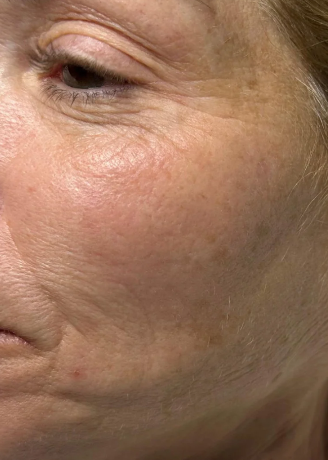 Before HydraFacial + Dermaplane