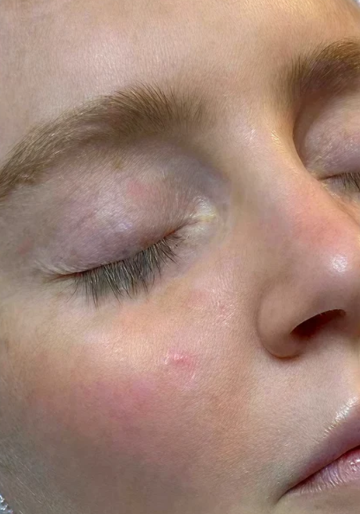 Before HydraFacial + Dermaplane
