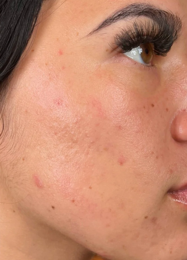 After HydraFacial + Dermaplane