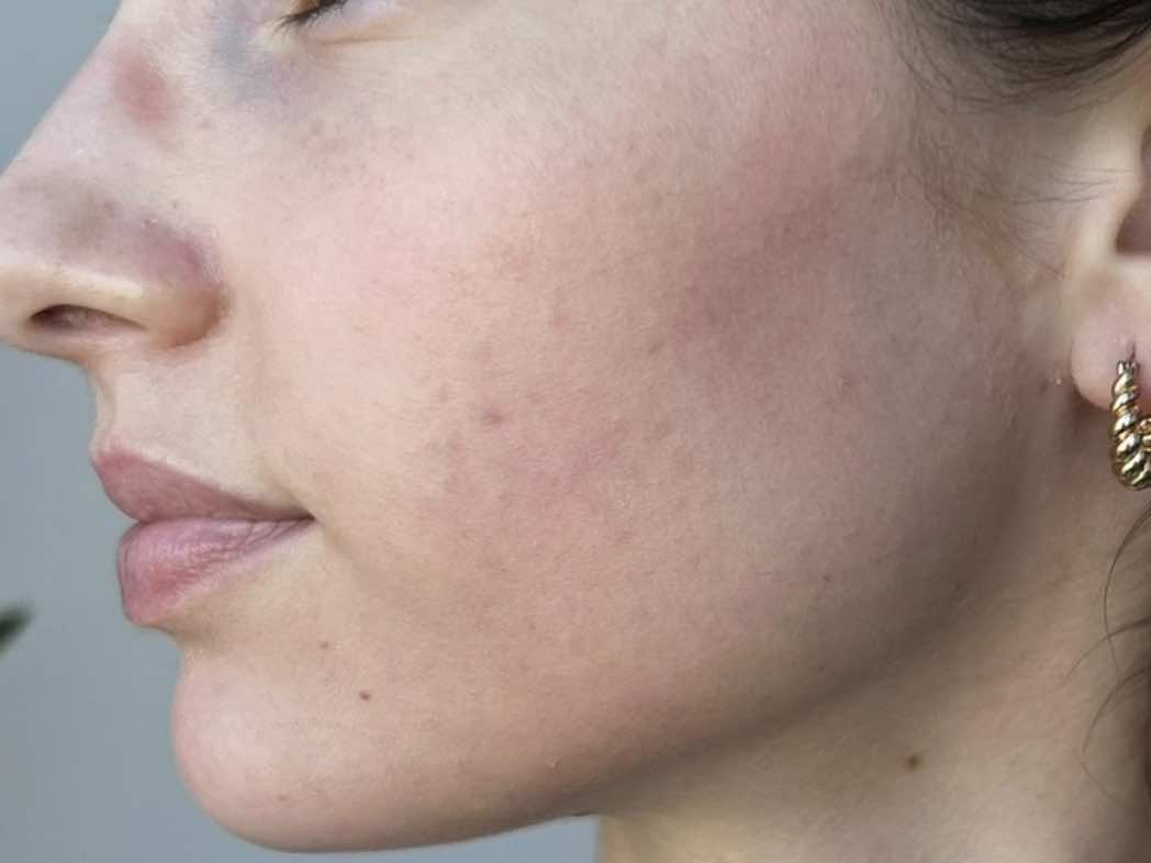After SkinPen Microneedling