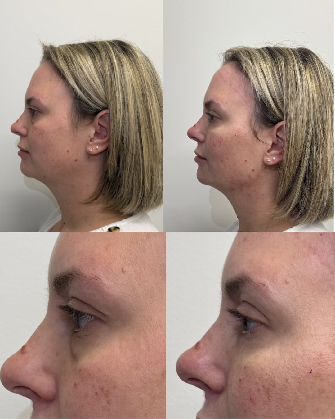 PRF Filler before and after
