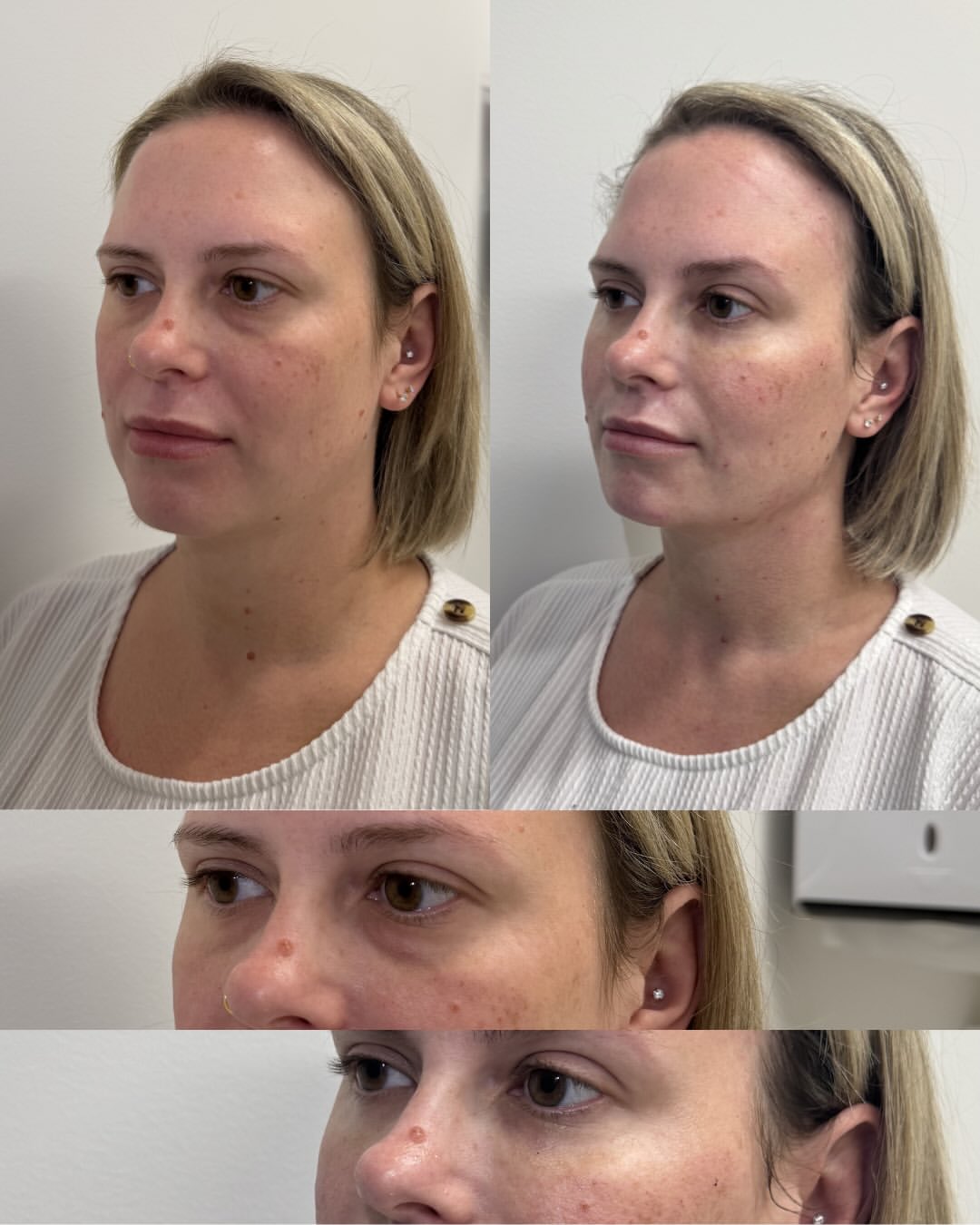 PRF Filler before and after