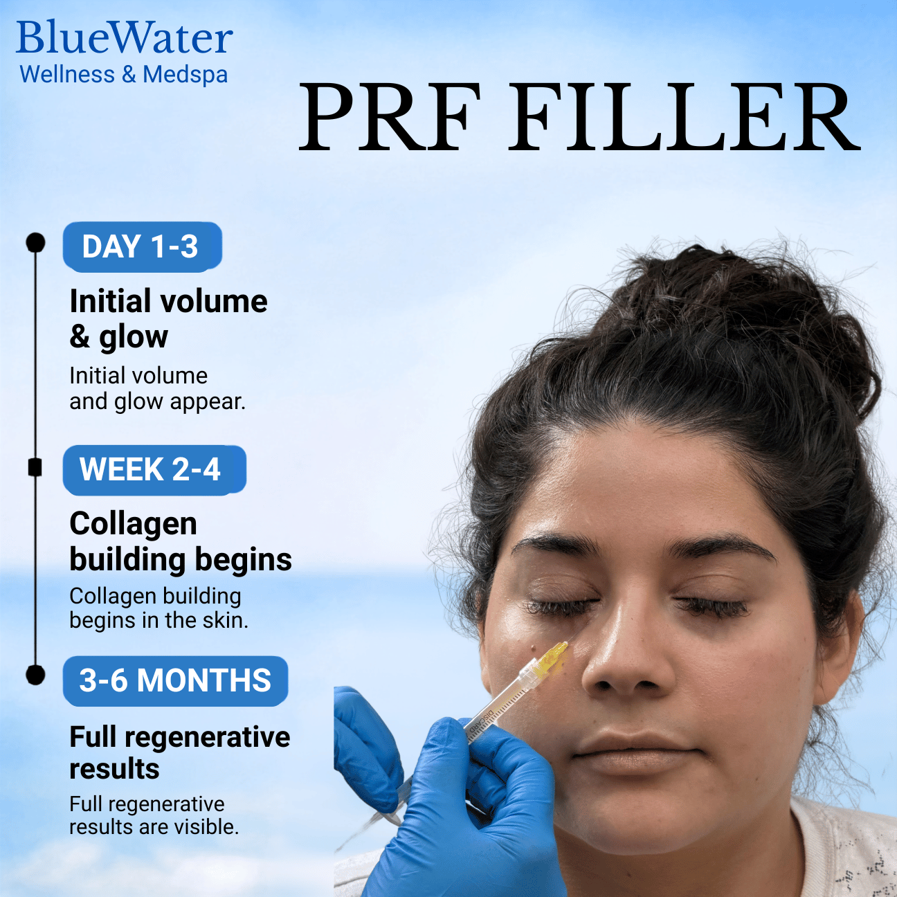 PRF Filler at BlueWater Wellness in Ponte Vedra, FL